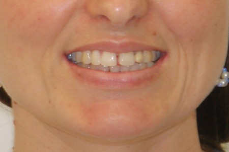 Diastema- úsměv před léčbou